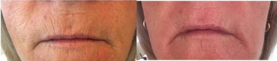 55-64 year old woman treated with Laser Treatment - Plasma Fibroblast (PlasmaLift) Smokers Lines
