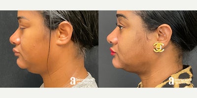 35-44 year old woman treated with AccuTite - The patient is a 36 year-old female who had aesthetic concerns with her submental/jowl region of the face. Dr. Cho performed Accutite to the lower face/neck and MyEllevate. The after results are 2 months post procedure.