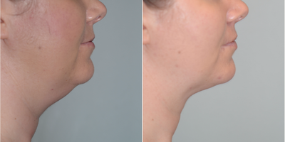 36 year old woman treated with CoolSculpting - This woman was treated with the CoolMini to her submentum. She is 3 months post her second treatment in her after photos.