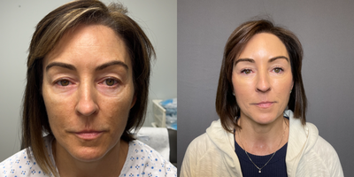 45-54 year old woman treated with Double Eyelid Surgery, Eyelid Surgery, Ptosis Surgery - Quad blepharoplasty.