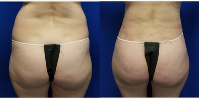 25-34 year old woman treated with Butt Augmentation - 37 year old female who had liposuction of the back and abdomen with fat transfer to the buttocks. Liposuction was performed using Vaser and Power Assisted Liposuction. A total of 3.5 Liters was removed with 1 liter from the lower back. 750cc's was placed in each buttock. The patient's height is 5 foot 3 inches. Her weight was 134 lbs. She has two children.