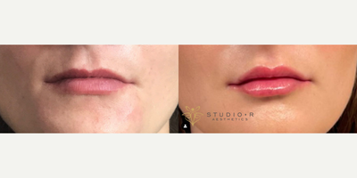 Woman treated with Lip Threading - This patient wanted a little more definition and pop for her thin lips. We used 4 pdomax threads to enhance her lip border. Over the next few weeks the swelling will decrease, the threads will settle in, and her body will begin making collagen as the threads dissolve.