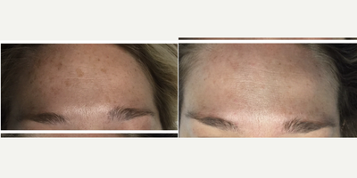 35-44 year old woman treated with Lumecca, IPL - Patient had one Lumecca IPL treatment for sun damage and brown spots on her forehead.