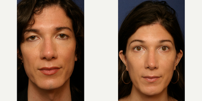 MTF Facial Feminization Surgery - Facial Feminization, Hairline Forehead Lift, Hairline Lowering, Orbital Bony Contouring, Tracheal Shave, Rhinoplasty, Lower Blepharoplasty and Soft Tissue to Nasolabial Folds45 - 54 Year Old