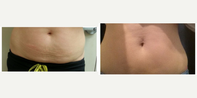 35-44 year old woman treated with Vanquish Body Sculpting - 40 year old woman received Vanquish Body Sculpting. Vanquish is an FDA-approved, non-invasive fat reducing method that utilizes a focus field radio frequency device. Vanquish is approved for deep tissue heating, a known method for targeting fat.