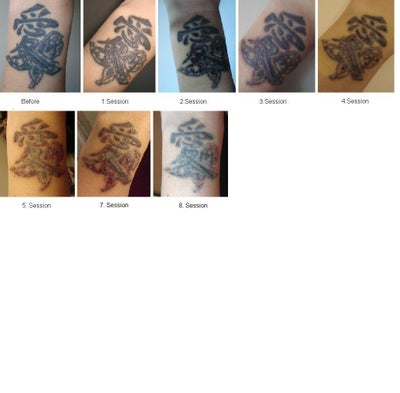 Laser Sessions on my Tattoos but Hardly Any Result? (photo) Doctor ...