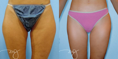 Thigh Liposuction  - 	Liposuction of the thighs Before & After