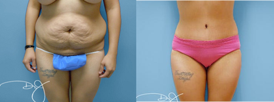 Tummy Tuck and Liposuction  - 	This patient had a Tummy Tuck and Liposuction