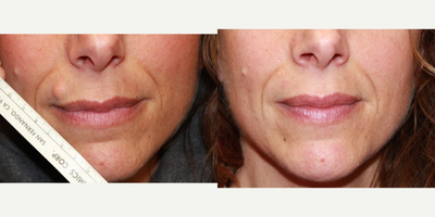 35-44 year old woman treated with Cyst/mole Removal From her Upper Lip - She had this cyst on the upper lip for many years and was afraid of removing it as she did not want a scar. Mole or cyst removals on the upper lip should heal very well if incisions are placed correctly in the vertical orientation.