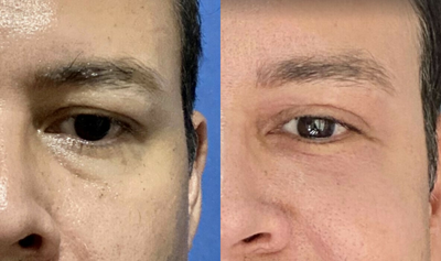 Man treated with PlasmaPen - Man treated with PlasmaPen