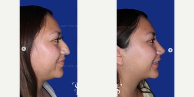 25-34 year old woman treated with Rhinoplasty, Chin Liposuction - 25-34 year old woman treated with Rhinoplasty, Chin Liposuction