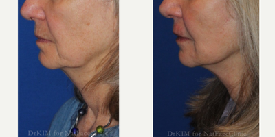55-64 year old woman treated with Facial Fat Transfer, Restylane, Nonsurgical Facelift - Patient had a Mid Face Fat Transfer from abdomen to bilateral cheeks and bilateral Marionette lines. She also had Restylane filler to her perioral area.