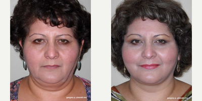 Woman treated with QuickLift - Woman treated with QuickLift