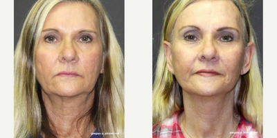 Woman treated with QuickLift - Woman treated with QuickLift