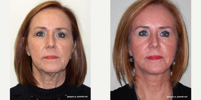 Woman treated with QuickLift - Woman treated with QuickLift
