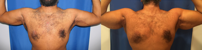 Man treated with Bicep Implants - Man treated with Bicep Implants