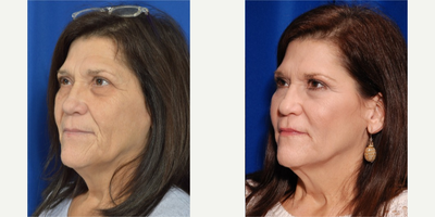 45-54 year old woman treated with Liquid Facelift - Patient treated with Juvederm Ultra and Juvederm Voluma by Facial Plastic Surgeon - Sean R. Weiss, MD