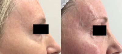 55-64 year old woman treated with TempSure Envi - Treated with TempSure Envi for the full face