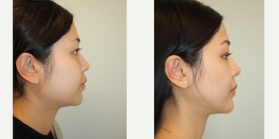 25-34 year old woman treated with Asian Rhinoplasty, Rhinoplasty, Genioplasty, Cheekbone Reduction, Buccal Fat Removal - Augmentation rhinoplasty with patients own diced cartilage and fascia (DCF Graft)