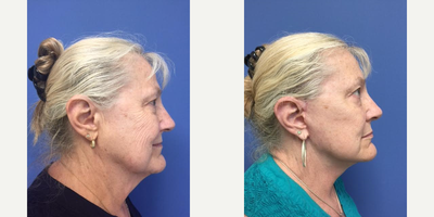 65-74 year old woman treated with Mini Lift - 65 year old female had a Monarch Mini Lift with SmartLipo of her neck.
