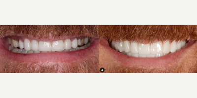 Woman treated with Dental Crown - After breaking multiple crowns over and over again, we discussed the full mouth reconstruction process with our patient to create a better bite, improve his TMJ symptoms, upgrade aesthetics, and discontinue the repeated breaking of crowns.