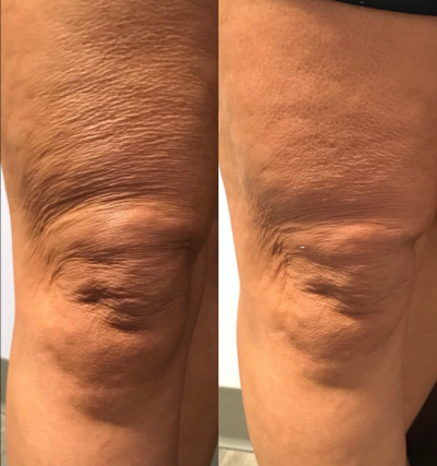35-44 year old woman treated with TempSure Envi - Two Treatments of TempSure Envi