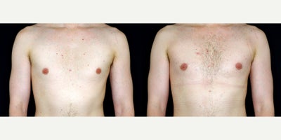 35 year old man treated with Breast Fat Transfer for enhanced size and symmetry - 35 year old man treated with Breast Fat Transfer for enhanced size and symmetry. Photos depict before and 1 month after surgery.