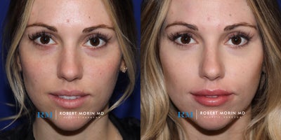 18-24 year old woman treated with Lip Augmentation - This 23 year old patient underwent a lip augmentation using 1ml of Juvederm Ultra. She is seen here immediately after the injection of both her upper and lower lips.