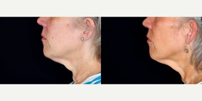 60 year old woman treated with Ultherapy to lower face and neck. - 60 year old woman treated with Ultherapy to lower face and neck. Photos depict before and 3 months after treatment.
