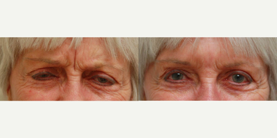 75 and up year old woman treated with Juvederm - Juvederm was used to fill in the deep crease between her eyebrows. Combined with botox, she was able to have a smooth glabella region.