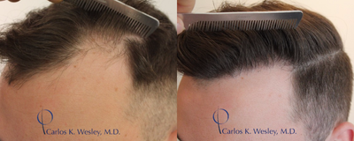35-44 year old man treated with FUE Hair Transplant - Patient treated with Follicular Unit Extraction (FUE)1 year post op. The hair follicles were incubated in autologous (his own) platelet rich plasma (PRP) throughout the duration of the procedure. This, combined with an ATP-containing storage solution has been shown to enhance survival of transplanted hairs.