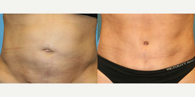 39 year old woman treated with Umbilicoplasty - This patient was concerned with the appearance of her belly button. She was treated with umbilicoplasty (done in conjunction with a tummy tuck).
