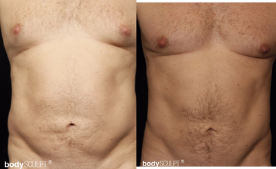 35-44 year old man treated with Smart Lipo - 40 year-old gentleman SmartLipo abdomen flanks