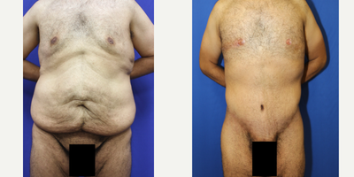 35-44 year old man treated with Body Lift - This patient underwent a 360 body lift. The procedure removes excess skin and fat from around the abdomen.