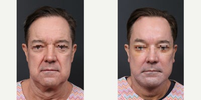 64 year old man treated with Deep Plane Face and Neck Lift, Endolift, Stem Cell Facial Fat Transfer, Submentoplasty, and Lower B - Deep Plane FaceNeck LiftEndoliftStem Cell Facial Fat TransferSubmentoplastyLower Blepharoplasty.