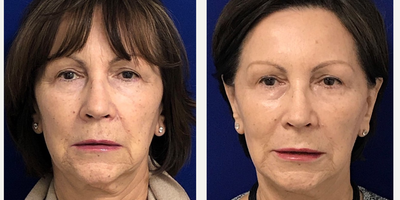 65-74 year old woman treated with Liquid Facelift - Liquid Facelift on my 70 years young patient. I used Restylane classic to plump her lips, Restylane Defyne in the nasolabial folds & marionette lines to soften & reduce the deep creases, Restylane Lyft in her cheeks to restore facial volume & to also lift the lower part of the face (jawline) and last but not least Dysport to address fine lines. 2 weeks post treatment, she is extremely happy with her rejuvenated appearance!