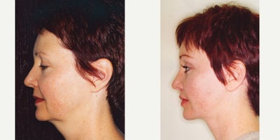 45-54 year old woman treated with Facelift - This patient underwent an upper lip lift, lower V2Y plasty to pout out the middle third of her lower lip as well as Dr. HAWORTH signature modified facelift.