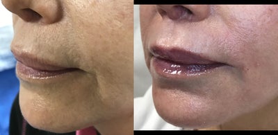 55-64 year old woman treated with Fractional CO2 Laser - Fractional CO2 laser resurfacing of perioral and upper lip area.