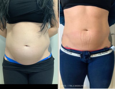 25-34 year old woman treated with truSculpt iD - 25-34 year old woman treated with one treatment oftruSculpt iD using 4 paddles