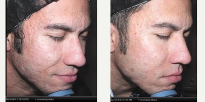 18-24 year old man treated with Microneedling - The POWER of PRF....Scientific research tells us PRF, platelet rich fibrin, is a very healing and regenerative serum that is also 100% natural! Here are real life results!!! These before and after photos were taken with our professional camera system! This patient has been treated ONLY twice with PRF microneedled into his skin to reverse acne scarring! How does it work? We draw your blood, spin it down in a special centrifuge and then extract out the PRF. Just think of what this healing serum can do to reverse the natural aging process!