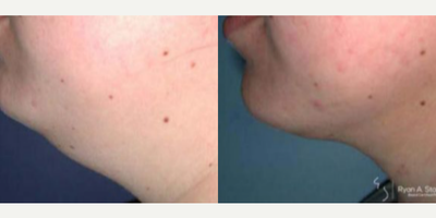 Woman treated with Chin Liposuction - Woman treated with Chin Liposuction