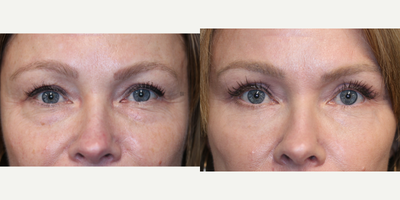 Upper and Lower Eyelid Surgery - Upper and lower eyelid surgery with laser.