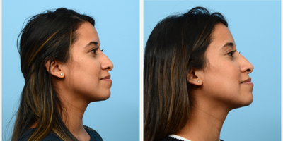 25-34 year old woman treated with Nonsurgical Nose Job, Dermal Fillers - Dr. Wise performed a non-surgical rhinoplasty on this patient to smooth the bridge of her nose and to subtly lift the tip.