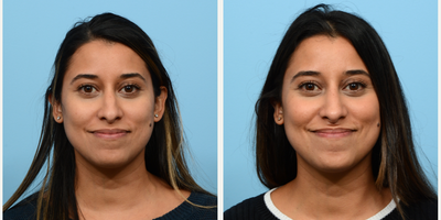 25-34 year old woman treated with Nonsurgical Nose Job, Dermal Fillers - Dr. Wise performed a non-surgical rhinoplasty on this patient to smooth the bridge of her nose and to subtly lift the tip.