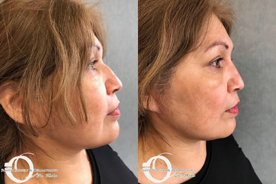 35-44 year old woman treated with Non Surgical Nose Job - Non surgical 5 minute nose job