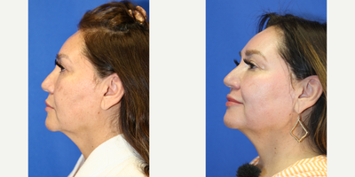 55-64 year old woman treated with Chemical Peel - This is a 57 year old Hispanic patient who was not happy with the uneven skin coloring, fine lines, and dark spots in her face. She had a chemical peel with Dr. J. Timothy Katzen in Beverly Hills, CA.  Notice the improvement in her skin, improved fine lines and dark spots.
