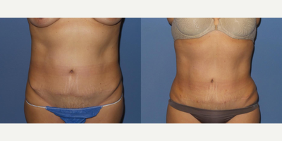 53 year old woman treated with BodyTite - This is a 53 y/o female who had BodyTite liposuction done to her abdomen, flanks, and bra rolls. She had a tummy tuck done by another surgeon several years ago and was unhappy with the dog ears at the ends of her scar and the remaining fullness. She has an excellent result with a much better waist and significant flattening of her dog ears with no skin excision necessary