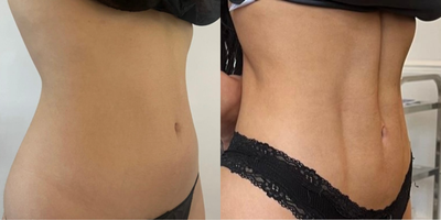 Vaser Liposuction results from October 2023 - April 2024 - Excellent transformation aided by a healthy diet and regular exercise, patient adhered to post-op guidance and had regular MLD massage post op. Patient desired increase muscle definition which is illustrated well in her results.