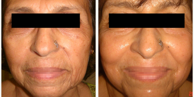 Infini RF - Photo provided courtesy of Lutronic, performed by Jagdish Sakhiya, MD