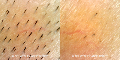 25-34 year old woman treated with Laser Hair Removal - Symptoms: excess hairTreatment: (1) laser hair removal treatment